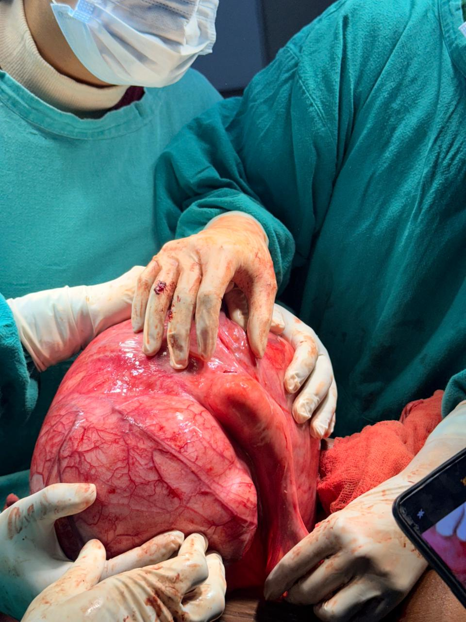 A 10 Kg Uterine Sarcoma removed from a patient in a high-risk surgery in Rama Hospital, Hapur